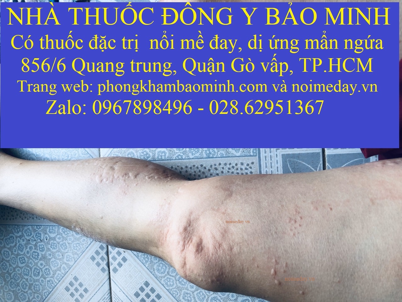 Bị dị ứng